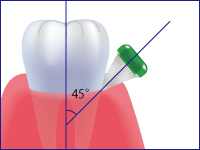 ブラッシング指導